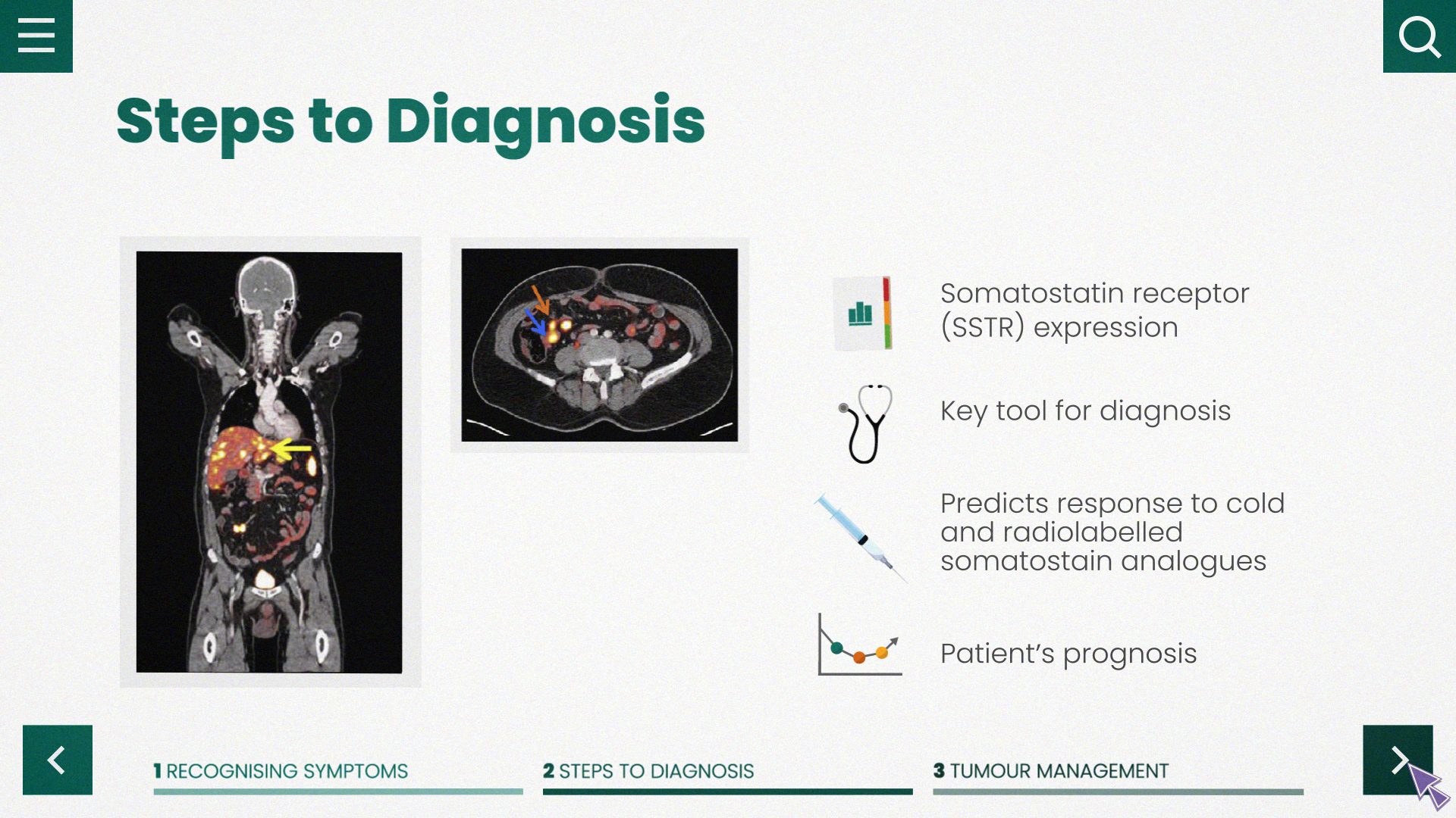 Recognising, Diagnosing and Managing Neuroendocrine Tumours